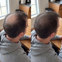 Hair Density Filler